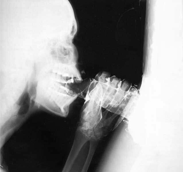 X-Ray